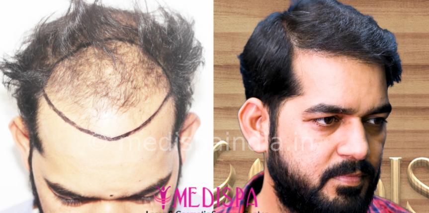 hair restoration price india
