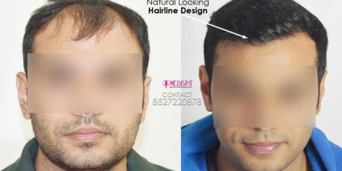 Best Hair Transplant in India in Grade 6 at Best Cost  Medispa India  Dr  Suneet Soni  YouTube