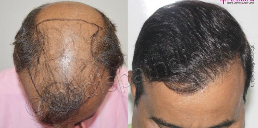 Hair Transplantation in Dubai for Black Women  Hair Transplant Dubai