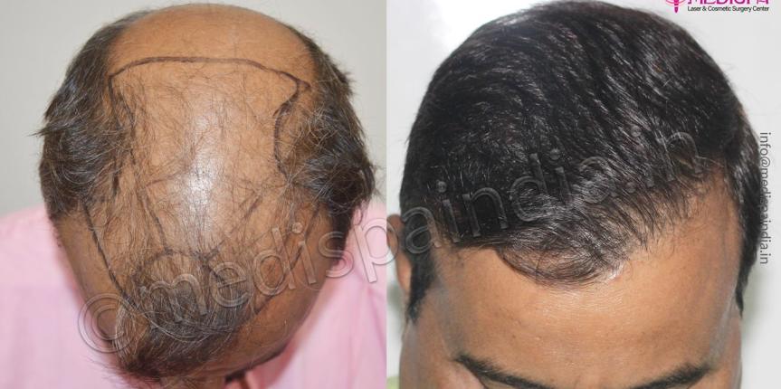 Hair Transplantation in Dubai for Black Women  Hair Transplant Dubai