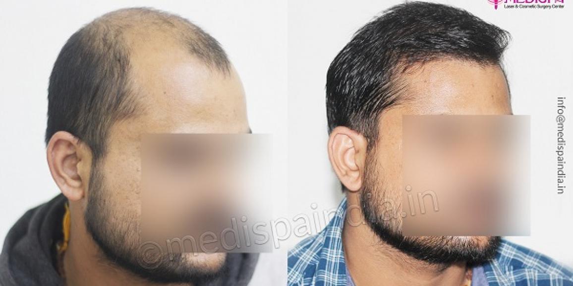 Hair Transplant in Ahmedabad  Clioncare Best Hair Transplant Clinic in  Ahmedabad