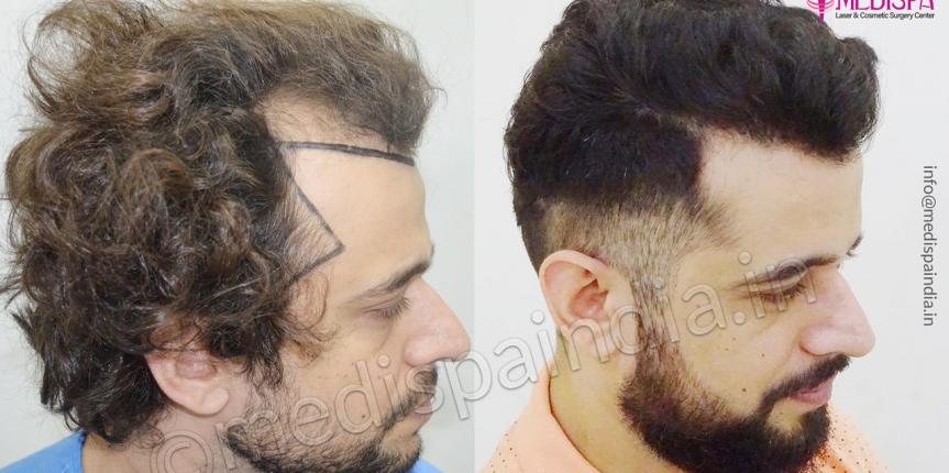 Celebrity Hair Transplants Beverly Hills - Celebrity Doctor Los Angeles -  AlviArmani