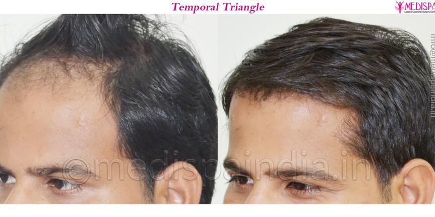 Hair Transplant Clinic in Delhi  Hair Loss Treatment in Delhi  DermaOne