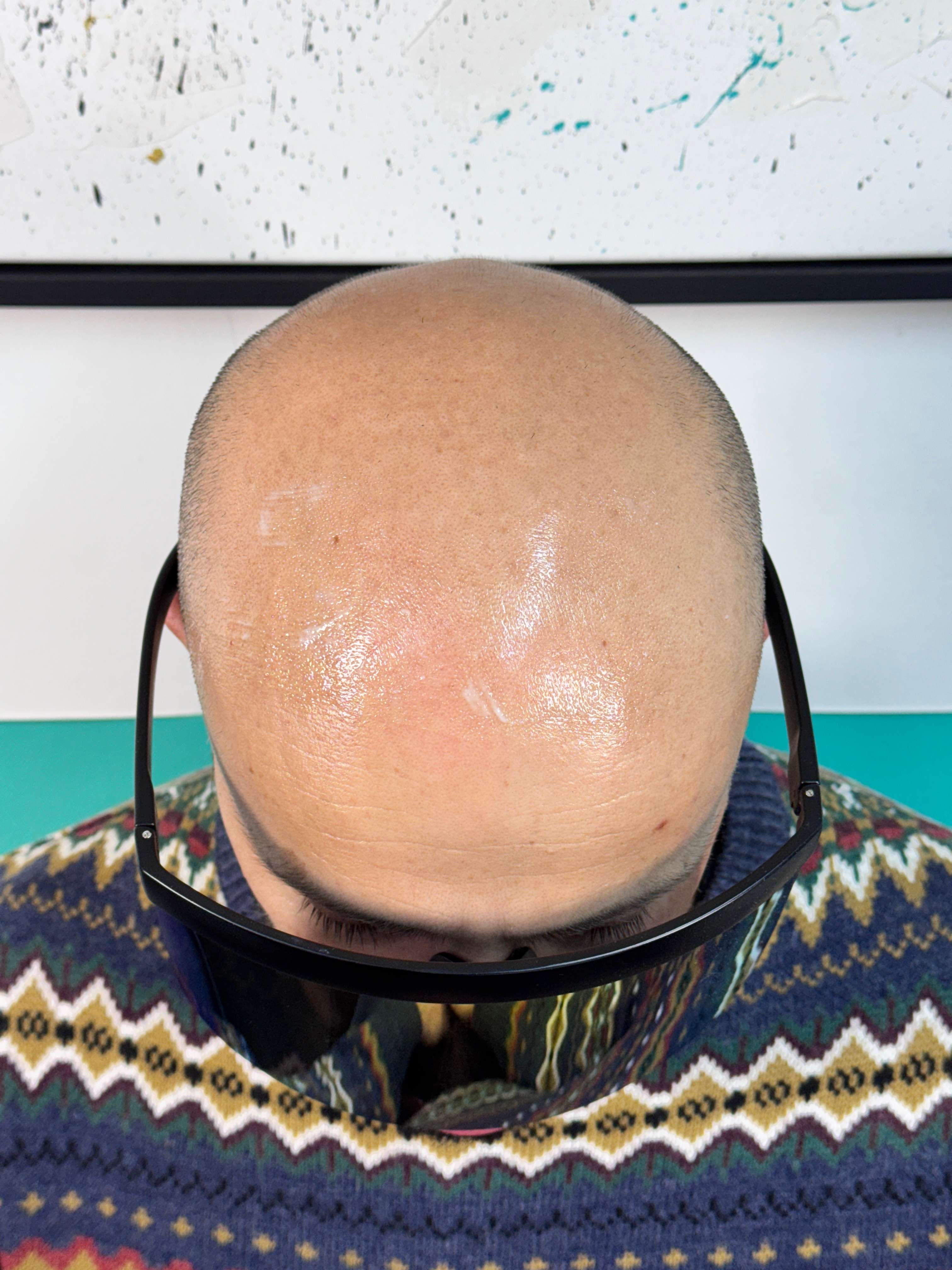 Paciente antes del tratamiento de micropigmentación capilar