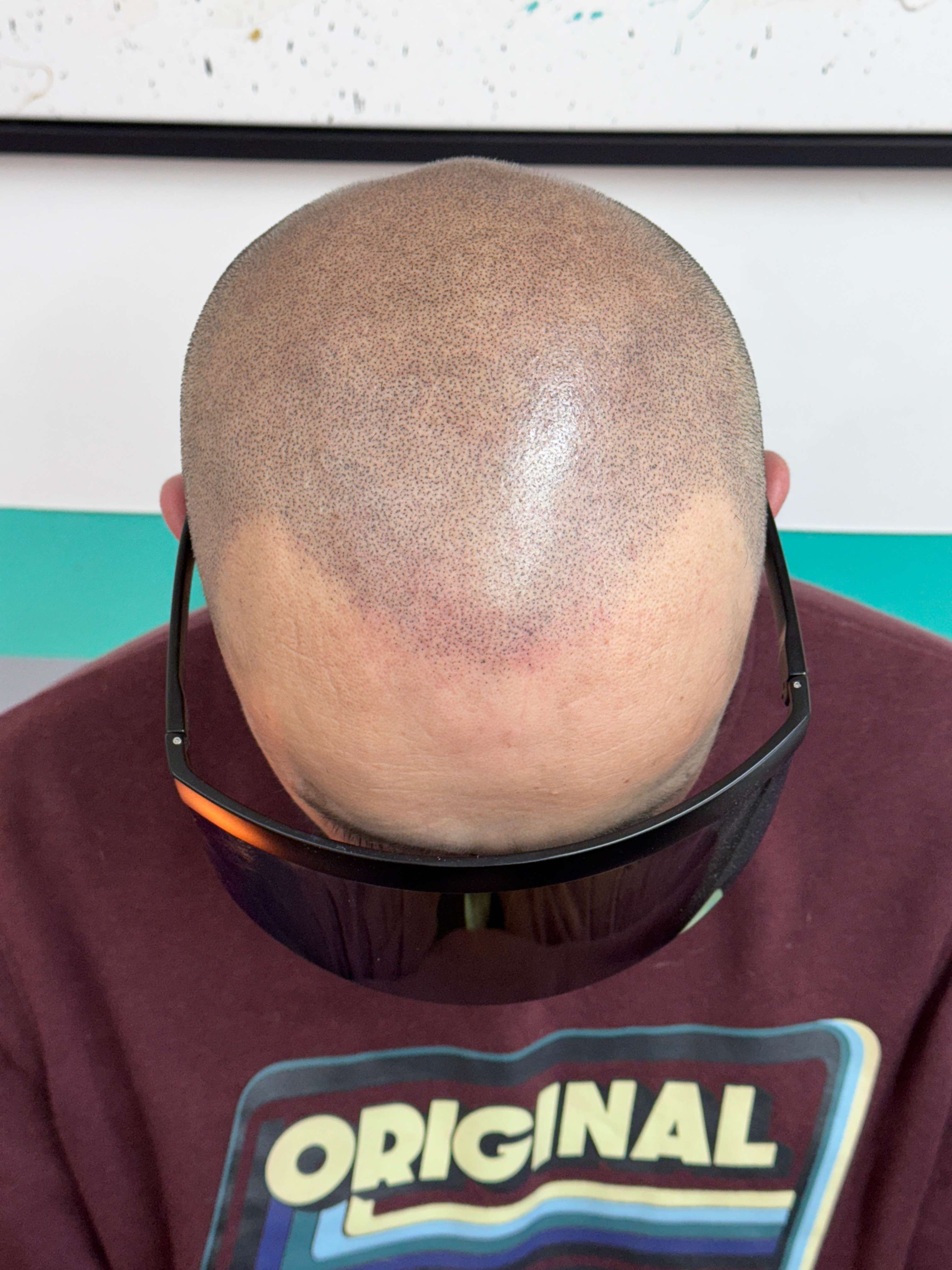 Paciente después del tratamiento de micropigmentación capilar - resultado natural