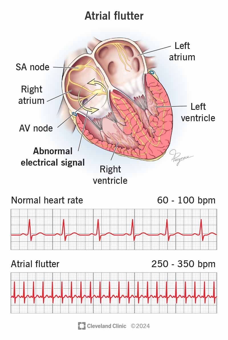 فلاتەری دەهلیزی (Atrial Flutter)