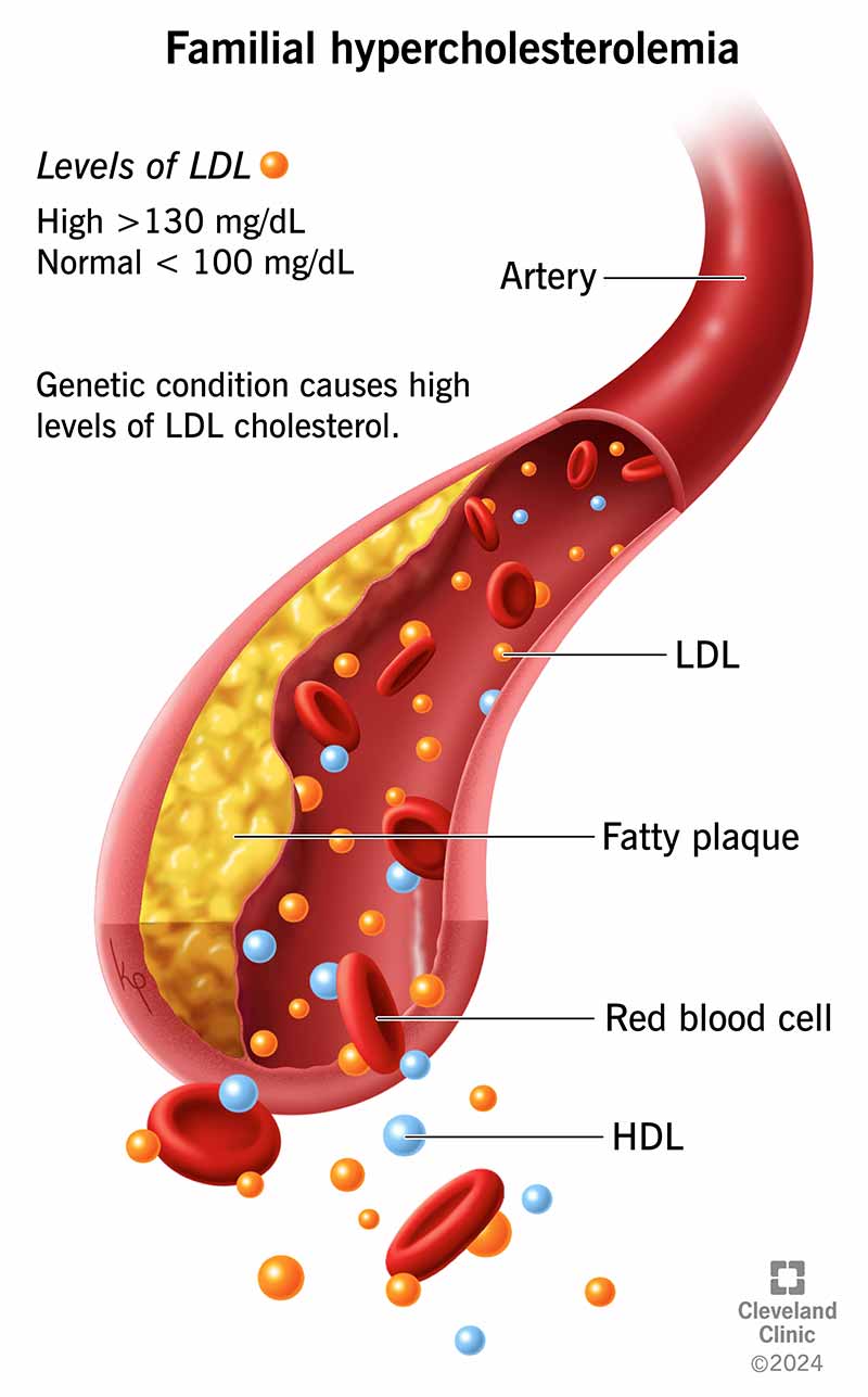 زیادەی کۆلێسترۆلی خێزانی (Familial Hypercholesterolemia)