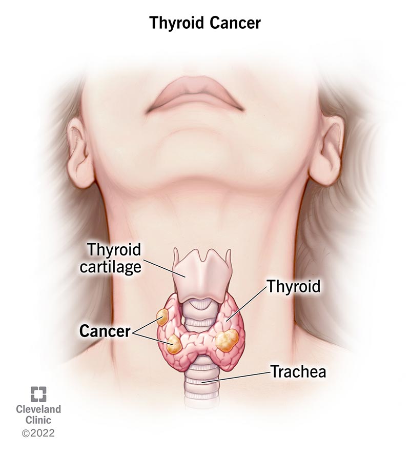شێرپەنجەی خولانجە (Thyroid Cancer)