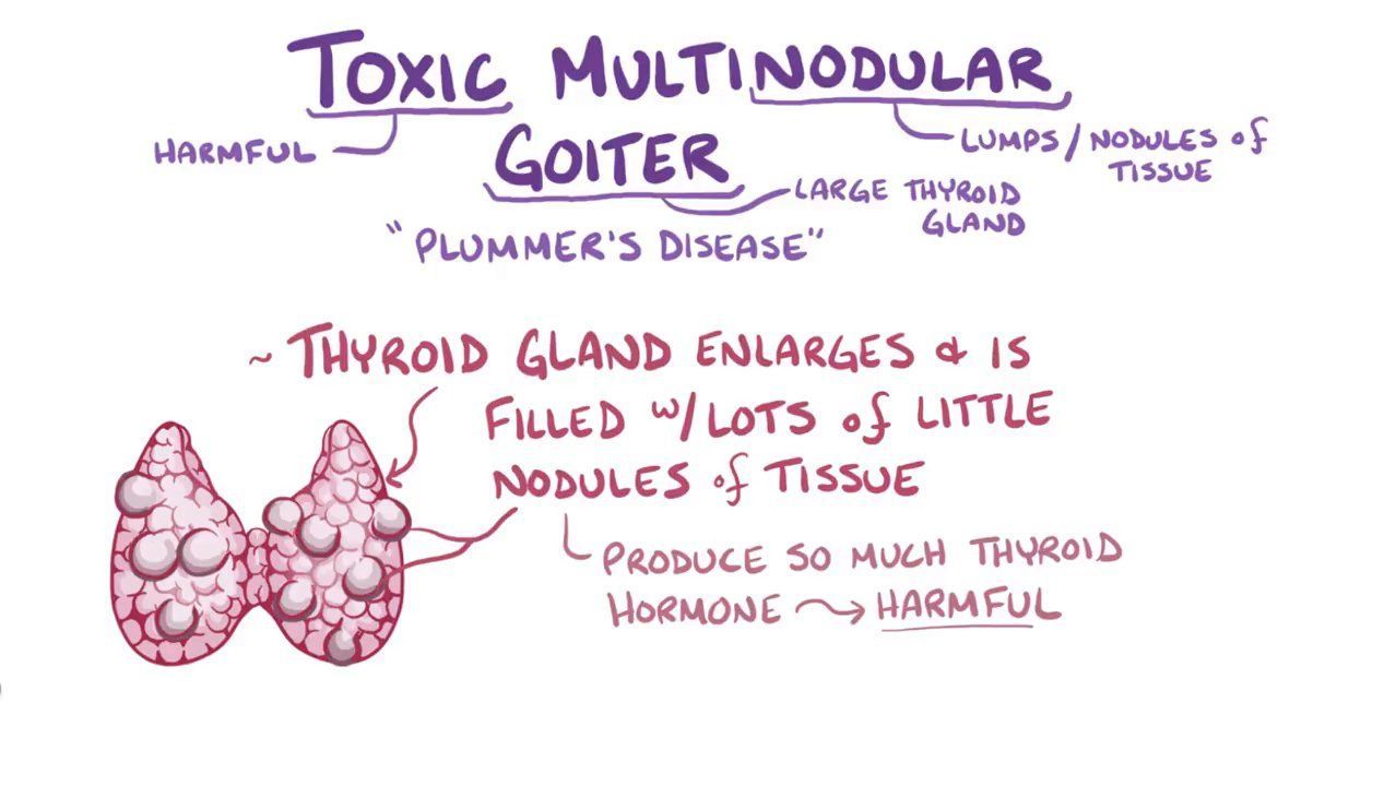 گورگەی چەندگرێی ژەهراوی (Toxic Multinodular Goiter)