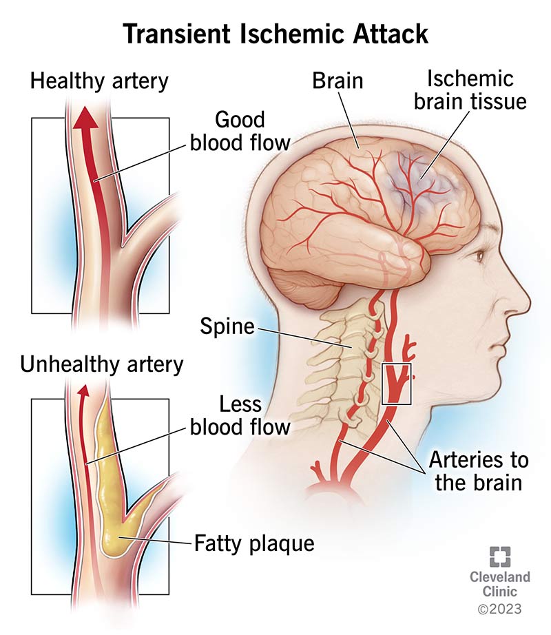 هەڵمەتی ئیسکیمیک کاتی (Transient Ischemic Attack)