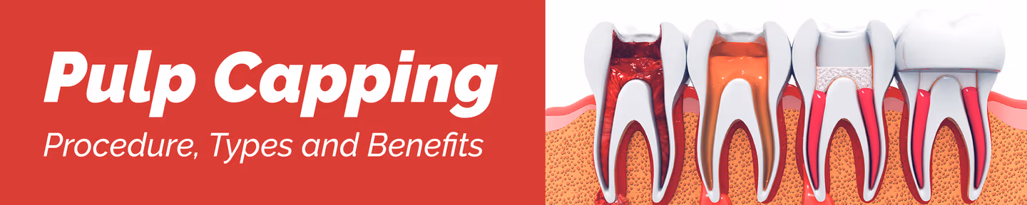 Pulp Capping - Procedure, Types and Benefits