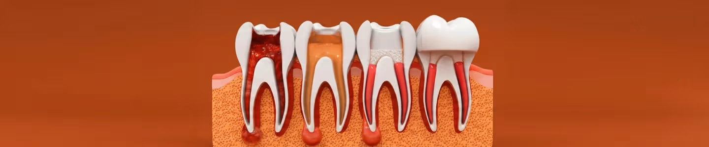 Pulp Capping - Procedure, Types and Benefits