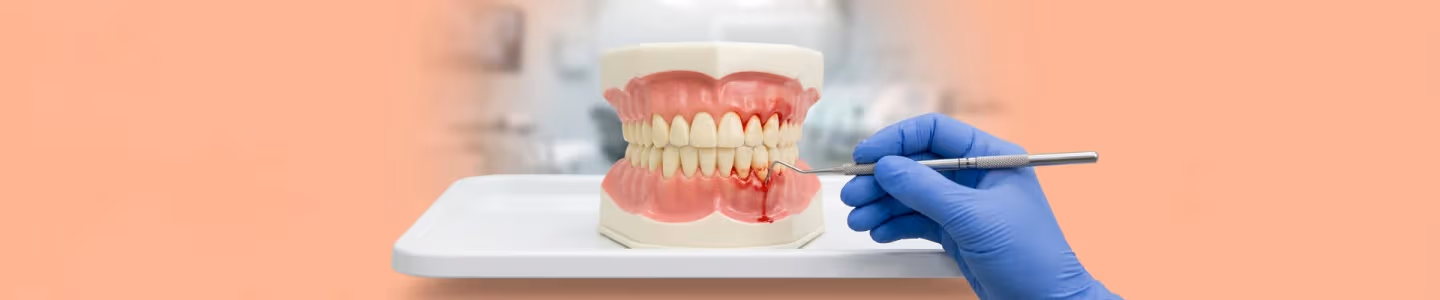 Understanding Periodontal Disease