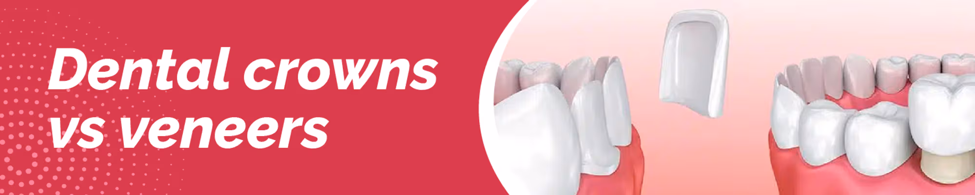 Dental Crowns vs Veneers: Which is Best for You?