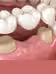 Crown & Bridge