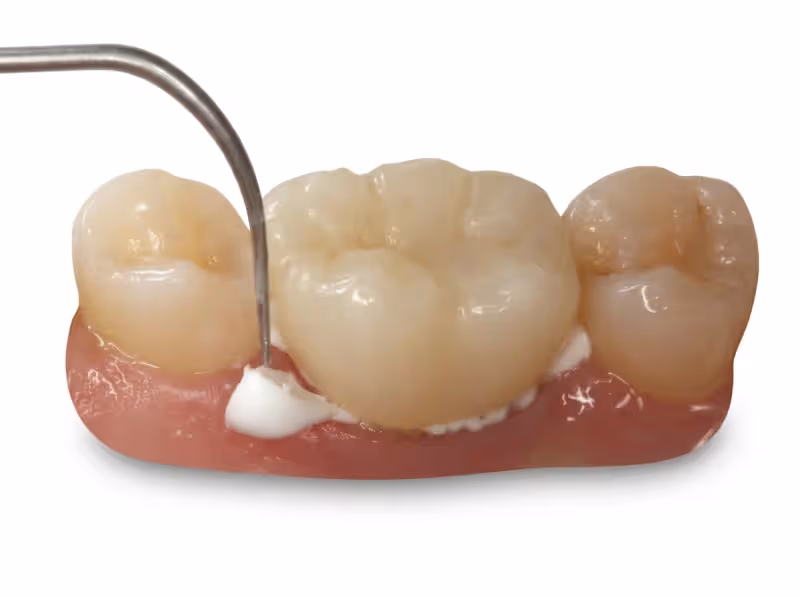 Pyrax Type I Luting GIC
