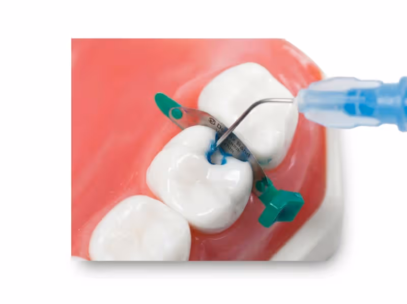 SafeEndo Smart Etch Etchant - 5ml