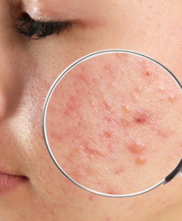 Como se livrar das tão temidas ACNES?