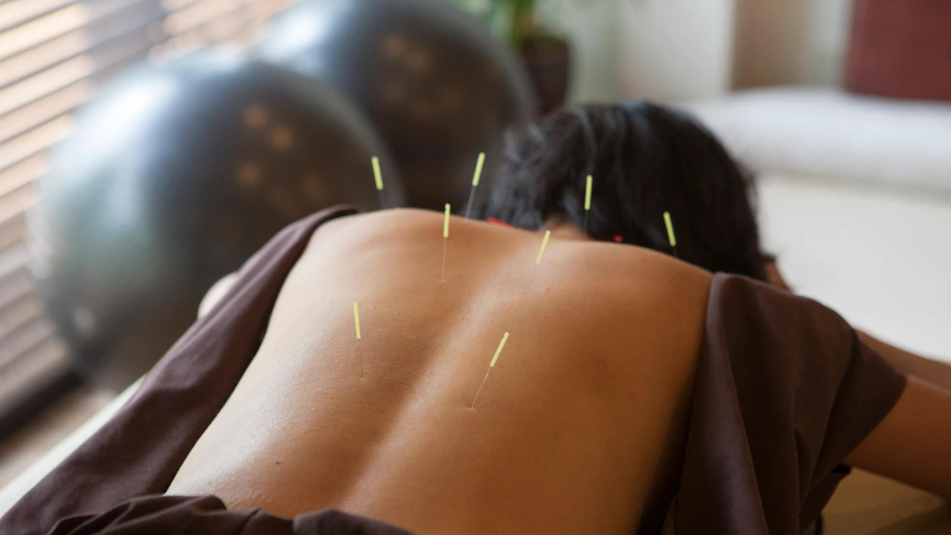 Acupuncture