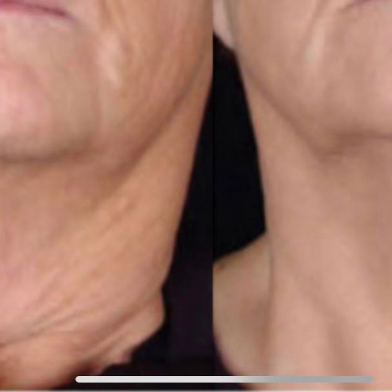 Thermalift Facift