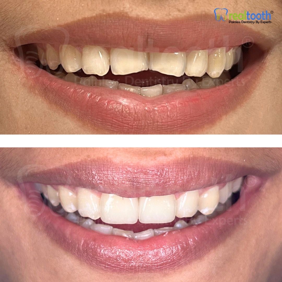 before-and-after,teeth-whitening,smile,dental