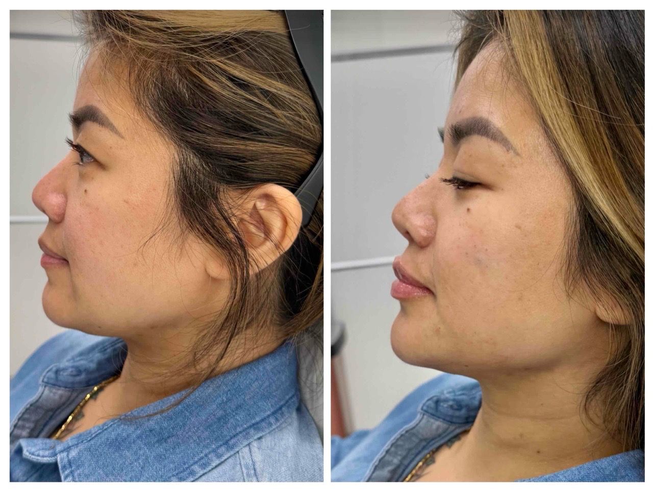 before and after,side profile,cosmetic procedure,transformation