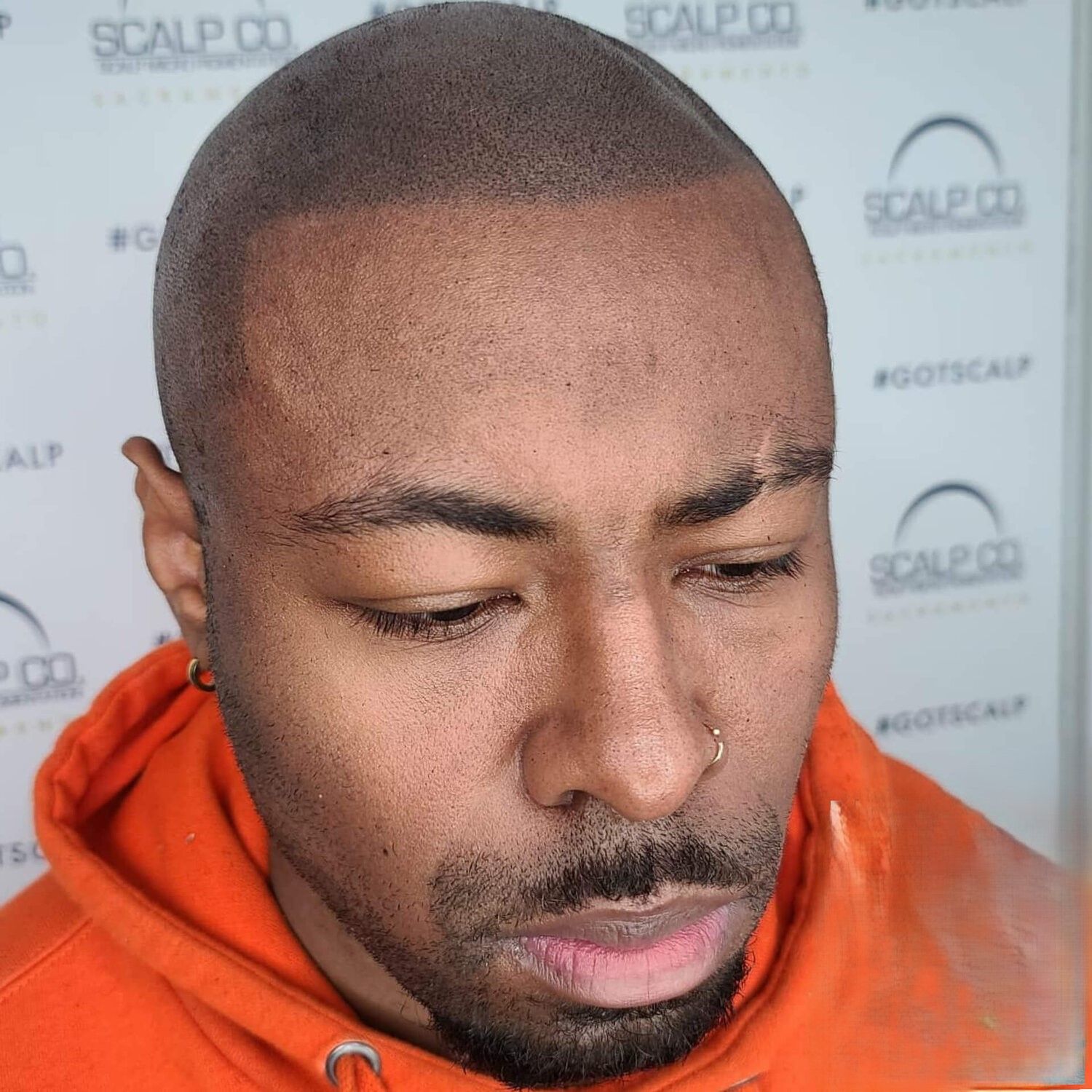Scalp Micropigmentation