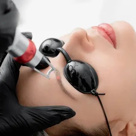 Permanent Makeup Removal