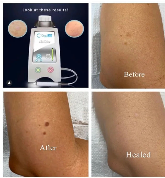 Dark Spot and Skin Tag Removal