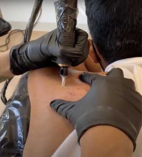 Body Scar Coverup & Camouflaging  service