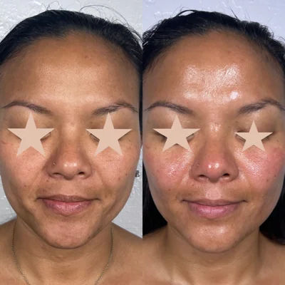  before-and-after,skincare,facial treatment,improvement 