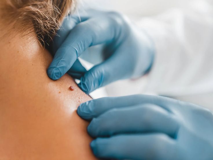 Skin Irregular Lesion Removal