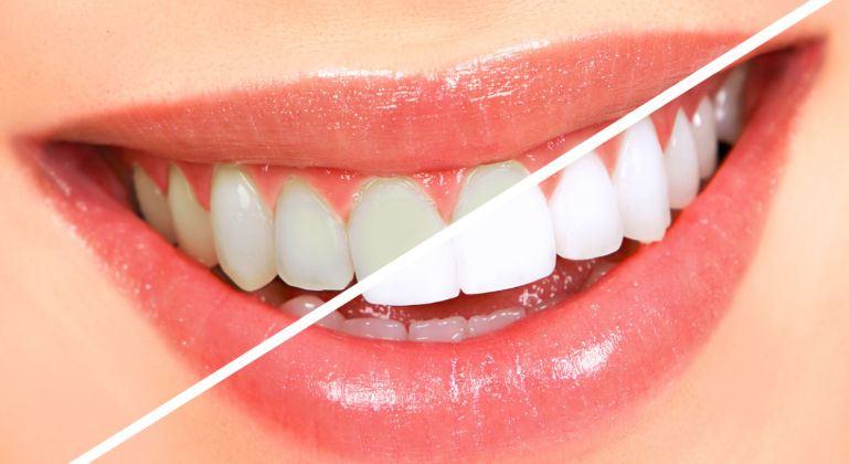 Teeth Whitening