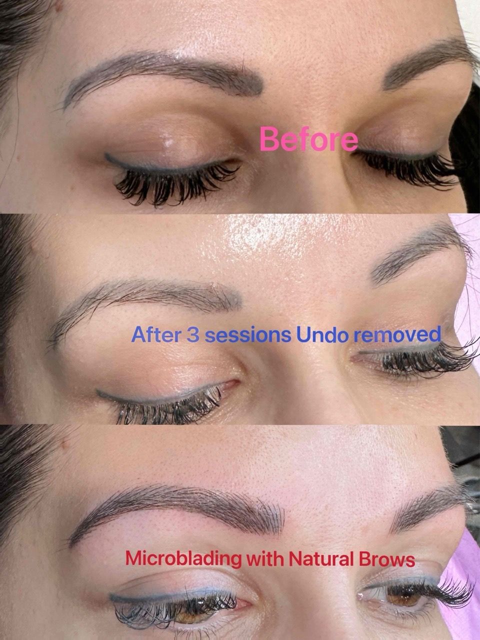 Non-Laser tattoo Removal