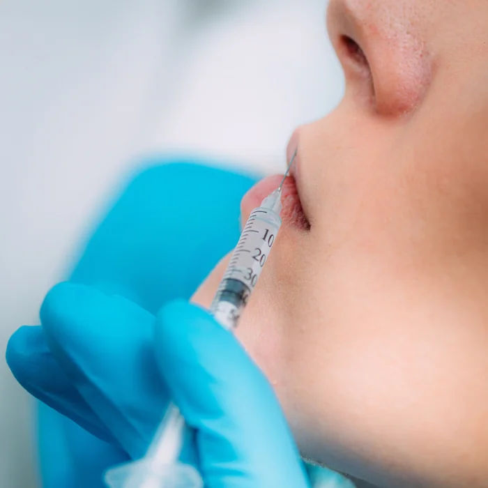 Dermal Fillers