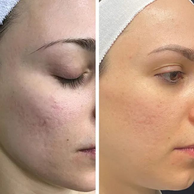 Skin Rejuvenation