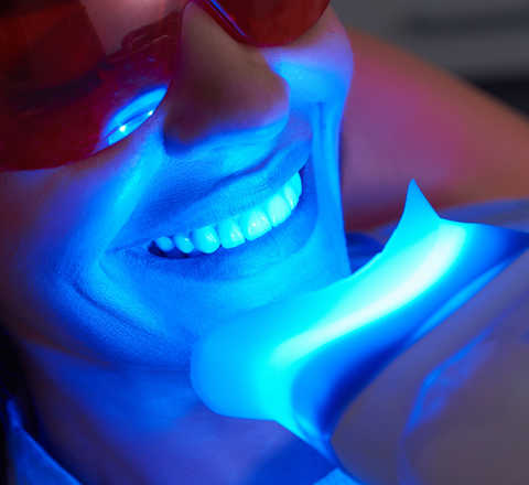 Teeth Whitening service