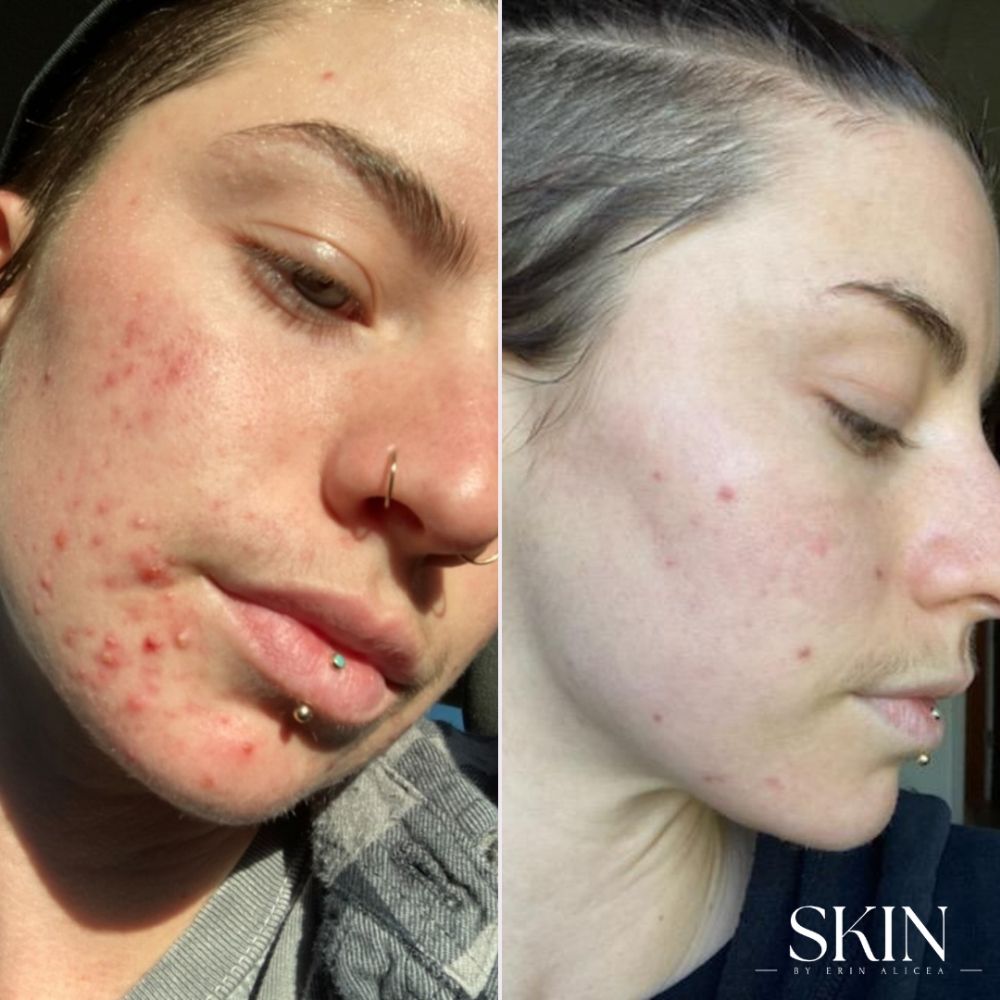 Acne Treatments
