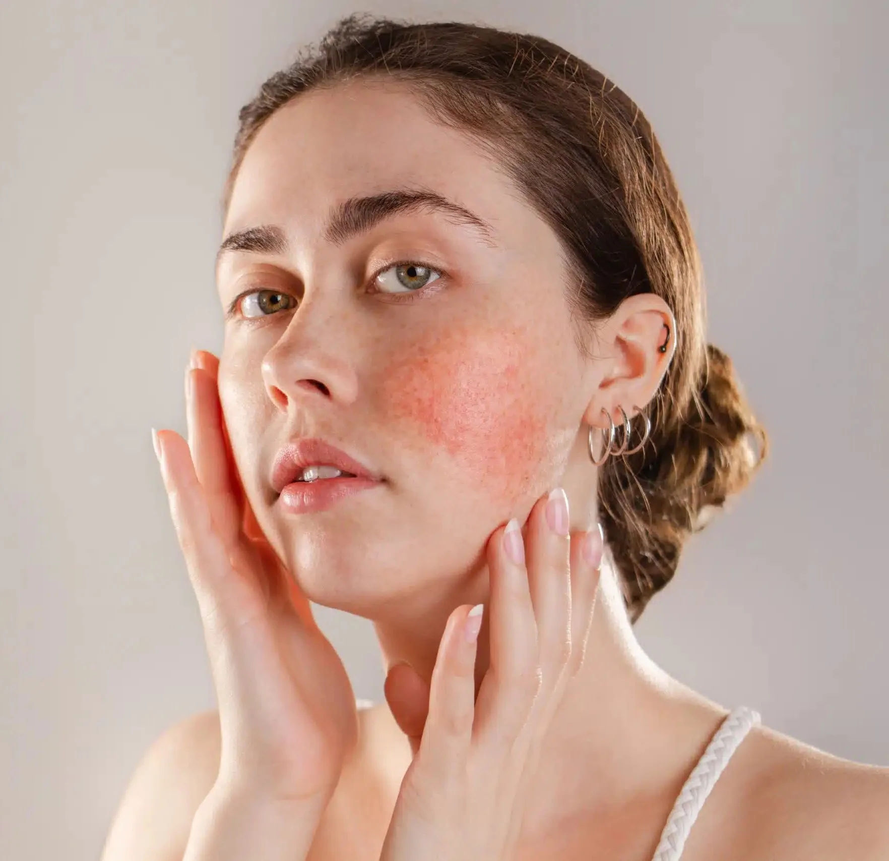 Initial Acne Appointment