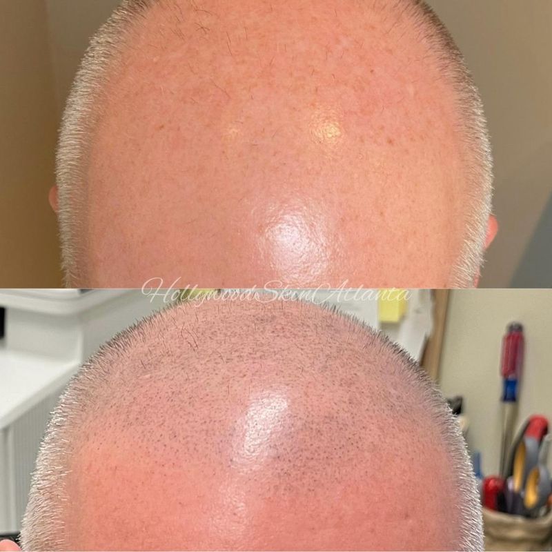 Scalp Micropigmentation