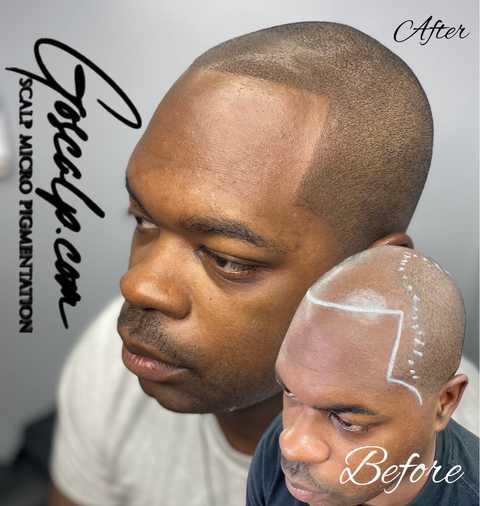 Front Hair Line Restoration