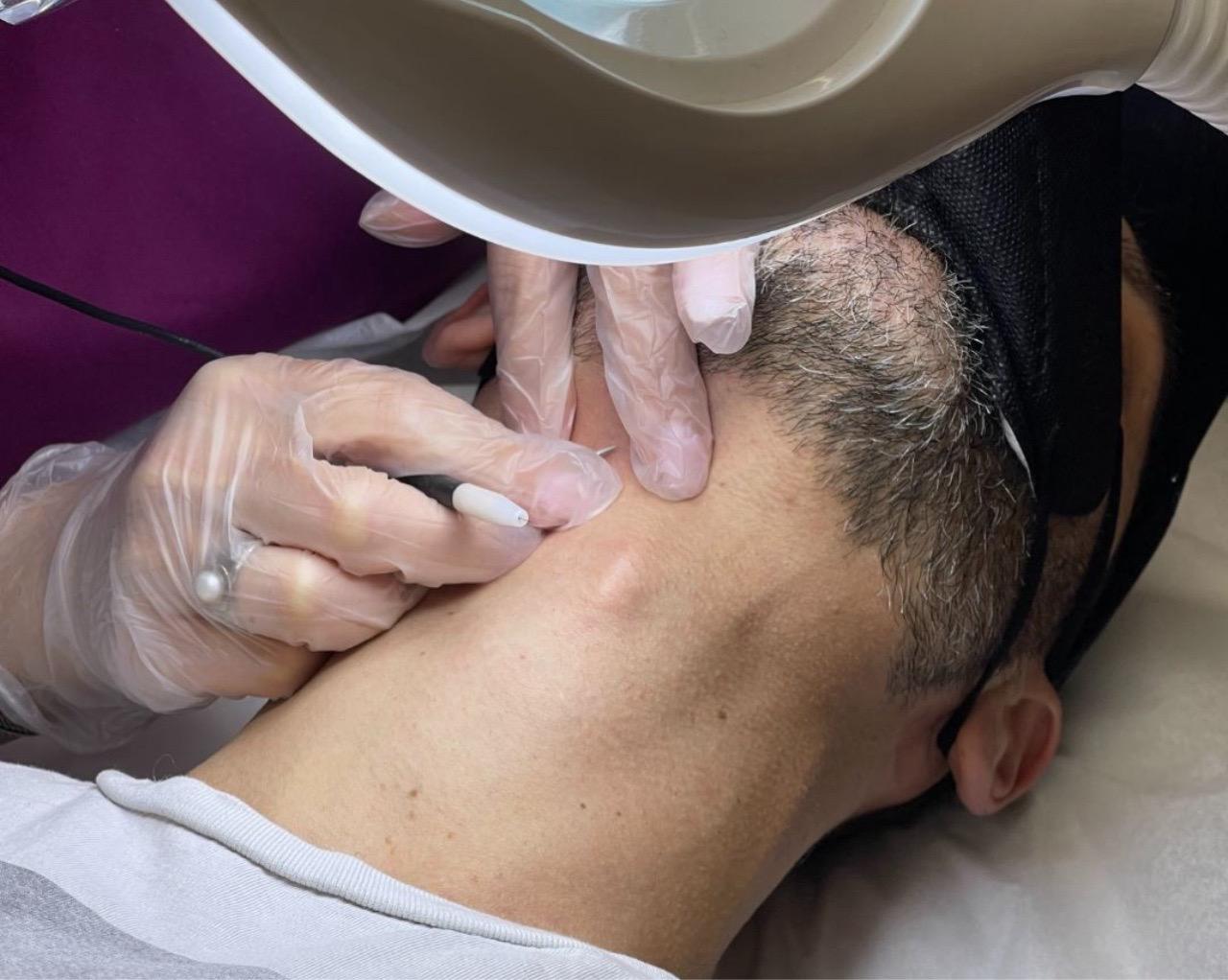 Electrolysis Hair Removal