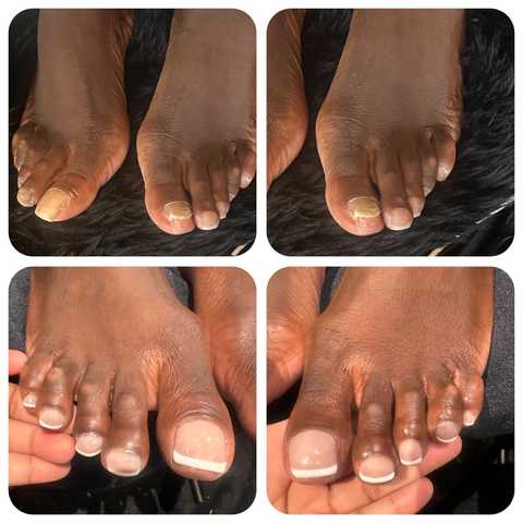 Toenail Reconstruction with Pedicure