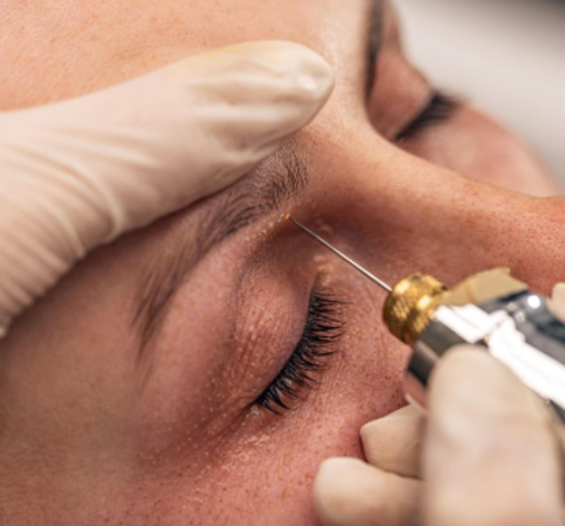 Fibroblast Skin Tightening
