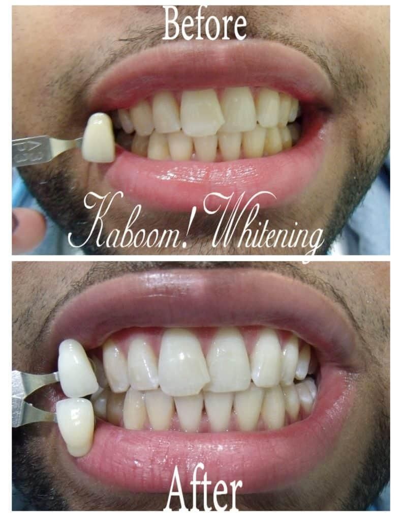  teeth whitening,before and after,dental,transformation,smile 