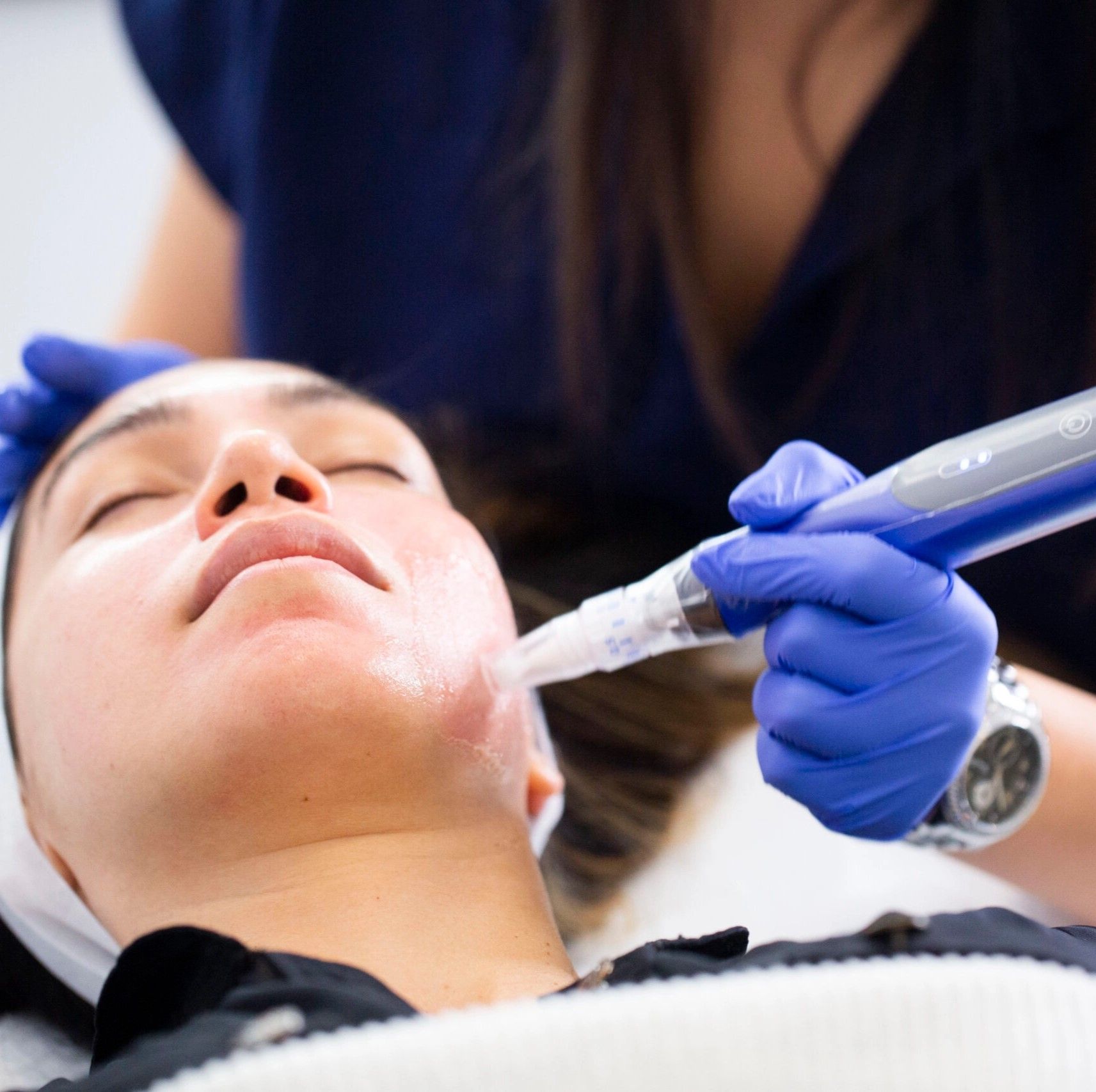 Microneedling