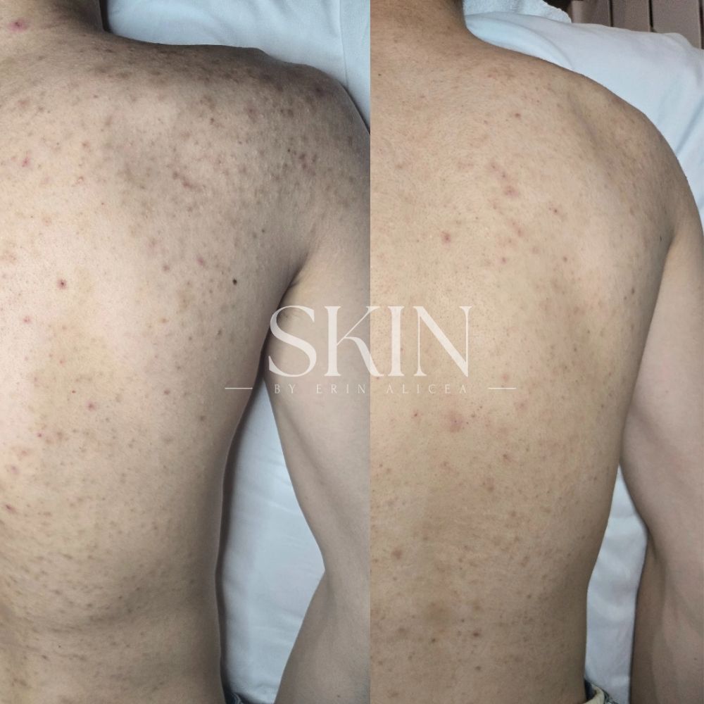 Body Treatments