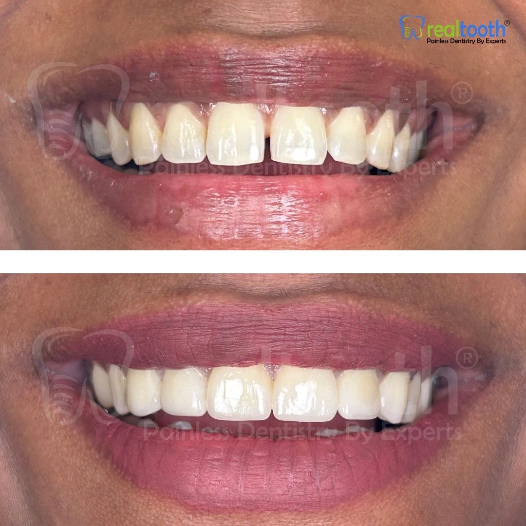  dental,smile,before-after,teeth-whitening  