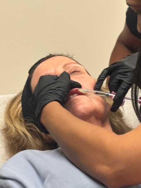 Juverderm - Lip Filler