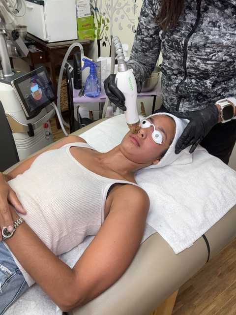 Micorneedling - Skin Revitalization And Resurfacing Per Session